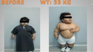 The two-year-old Saudi patient is seen here before bariatric surgery to reduce his weigh