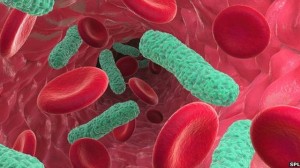 Sepsis bacterial blood infection (BBC)