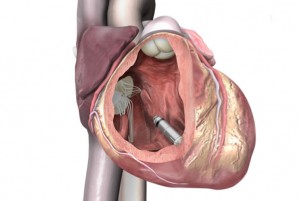 The pacemaker is delivered via a catheter through the femoral vein and positioned inside the right ventricle of the heart. (Credit: Medtronic)