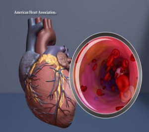 Heart illustration with artery close up Heart graphic with magnifier on artery (American Heart Assn.)