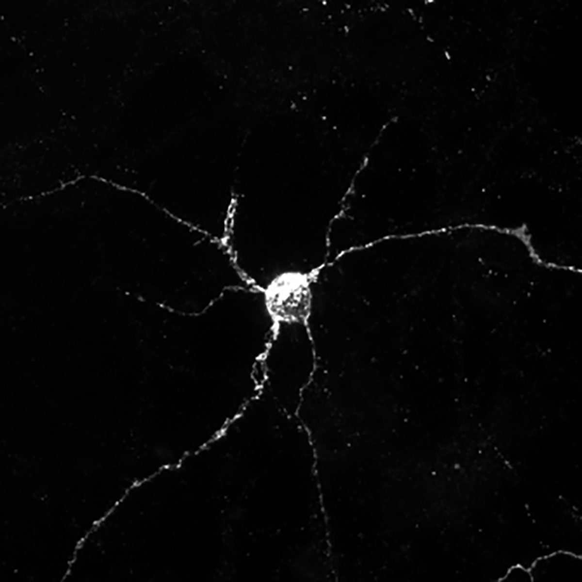 New study suggests cancer drug could be used to target protein connection that spurs Parkinson’s Disease